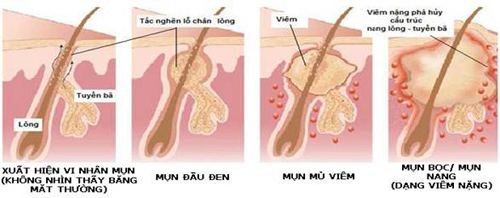 vi-sao-lai-co-mun